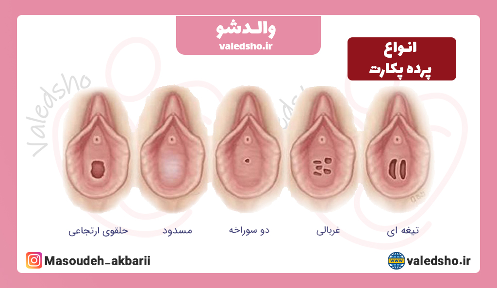 محل پرده بکارت هایمن با عکس