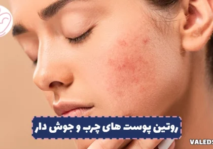 بهترین روتین پوستی برای پوست های چرب و جوش دار