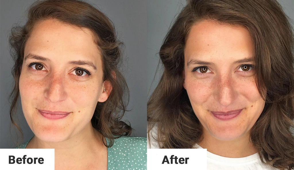 هیالورونیک اسید 6 هیالورونیک اسید برای پوست