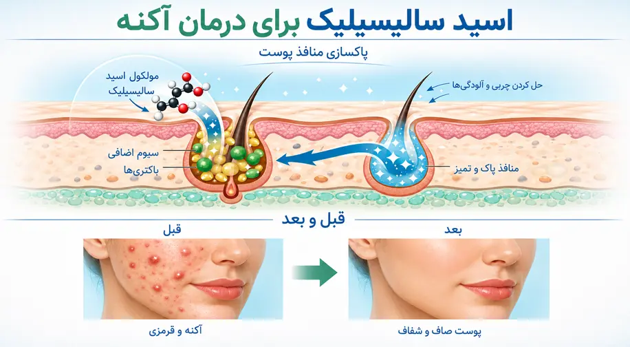 سالیسیلیک اسید چیست و چطور جوش را از بین میبرد؟ 1 درمان جوش