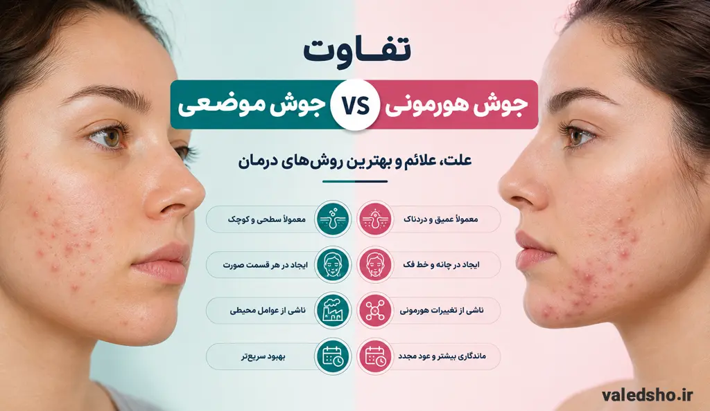 تفاوت جوش موضعی و جوش هورمونی 1 تفاوت جوش موضعی و جوش هورمونی