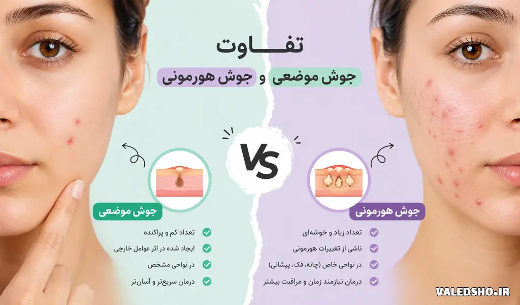 فرق جوش هورمونی با جوش معمولی